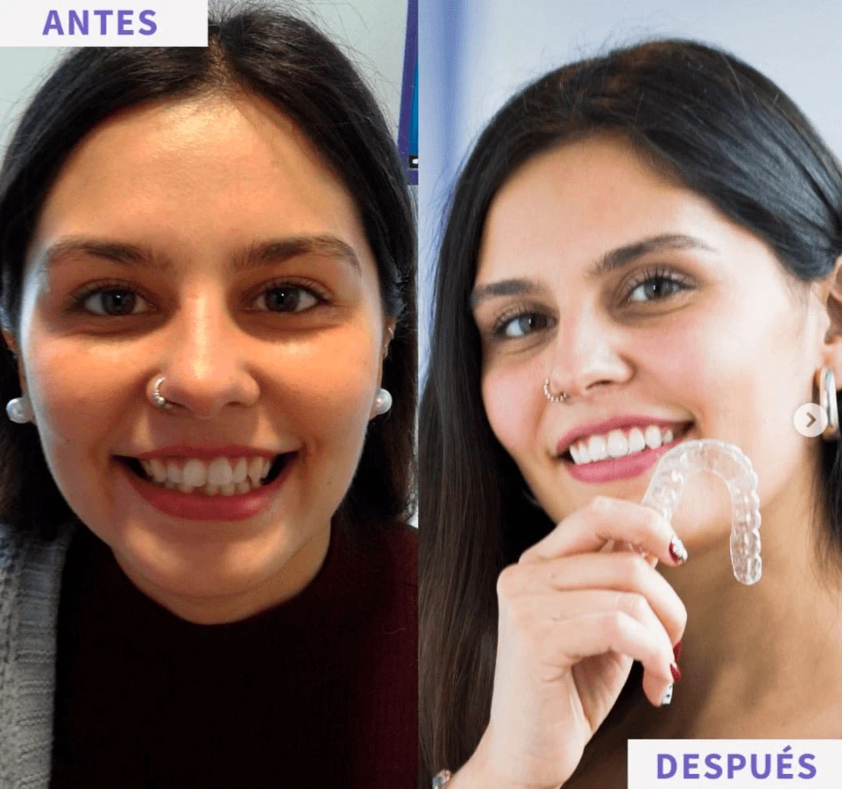 antes y después de paciente que alineo sus dientes con ortodoncia invisible