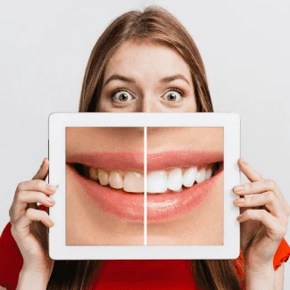 Blanqueadores dentales caseros de farmacia: ¿Son efectivos?