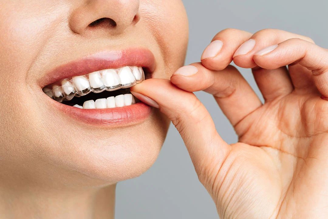 ¿Los alineadores invisibles no funcionan?