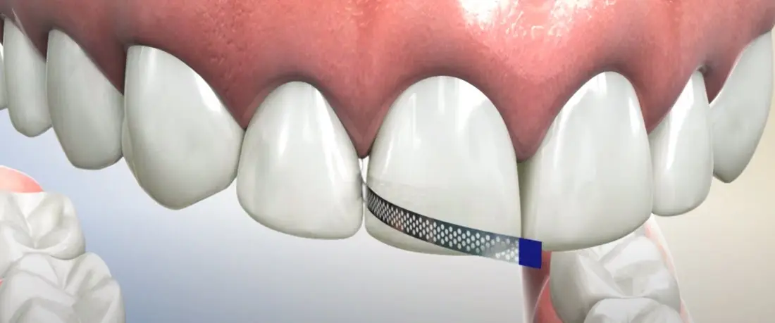 Desgaste Interproximal En Ortodoncia | Ortodoncia Junin