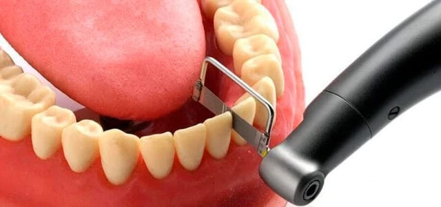 ¿Qué es el Stripping y cómo mejora tu tratamiento de ortodoncia?