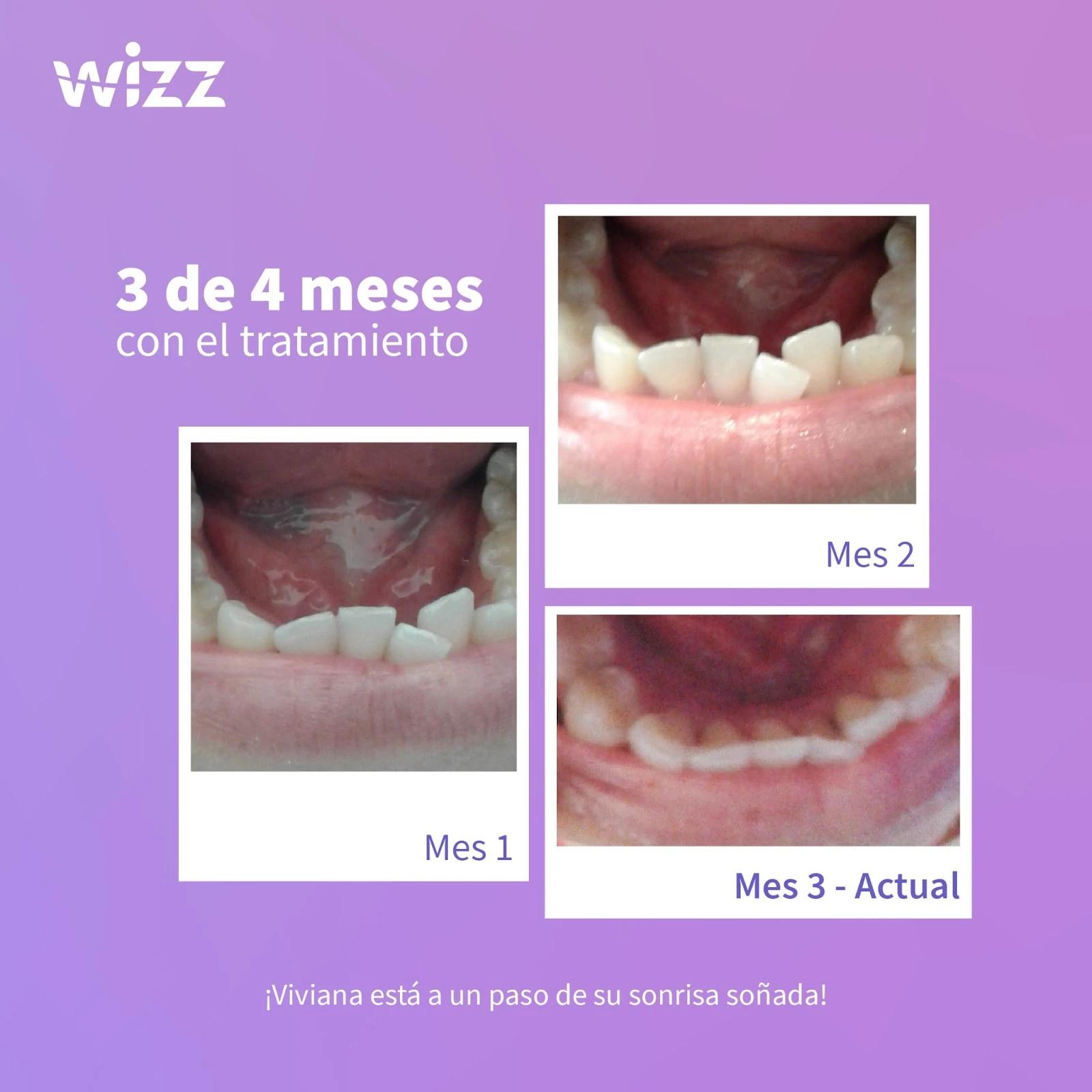 Evolución de un paciente en 3 meses con alineadores invisibles