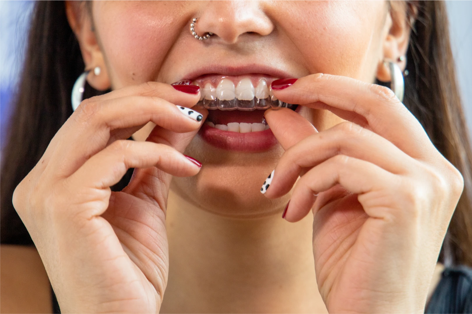 Importancia de los retenedores al terminar tu tratamiento de ortodoncia invisible