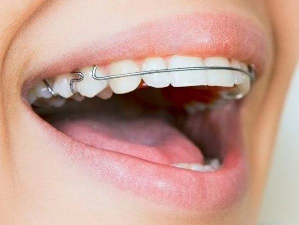 dientes con retenedores fijos