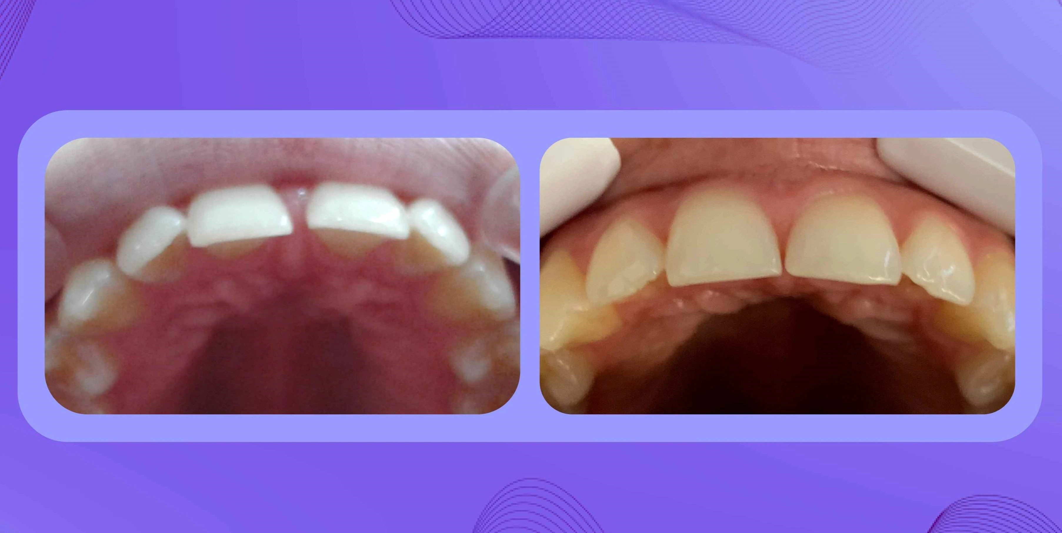 Antes y después de paciente con diastema