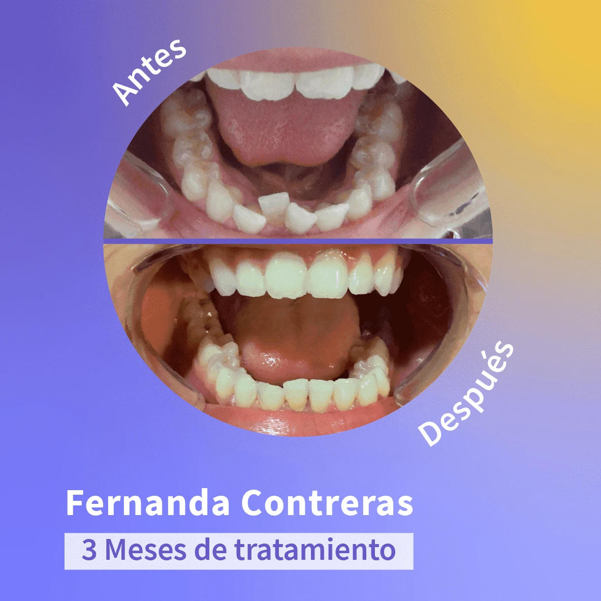 Cambio de una sonrisa luego de tres meses utilizando los alineadores invisibles de Wizz.