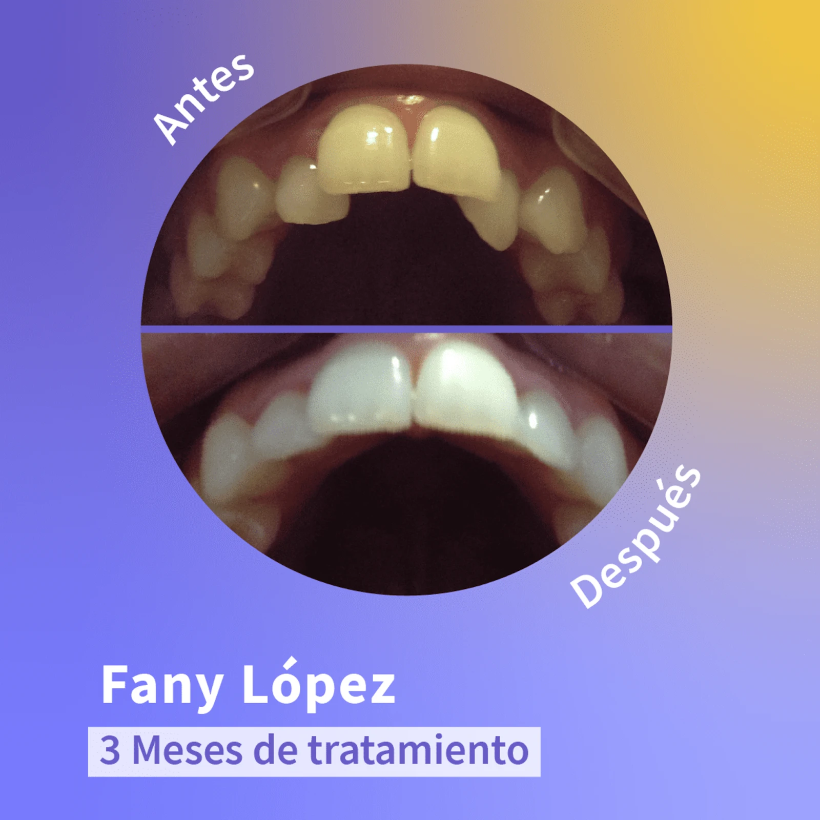 Cambio de una sonrisa luego de tres meses usando ortodoncia invisible.