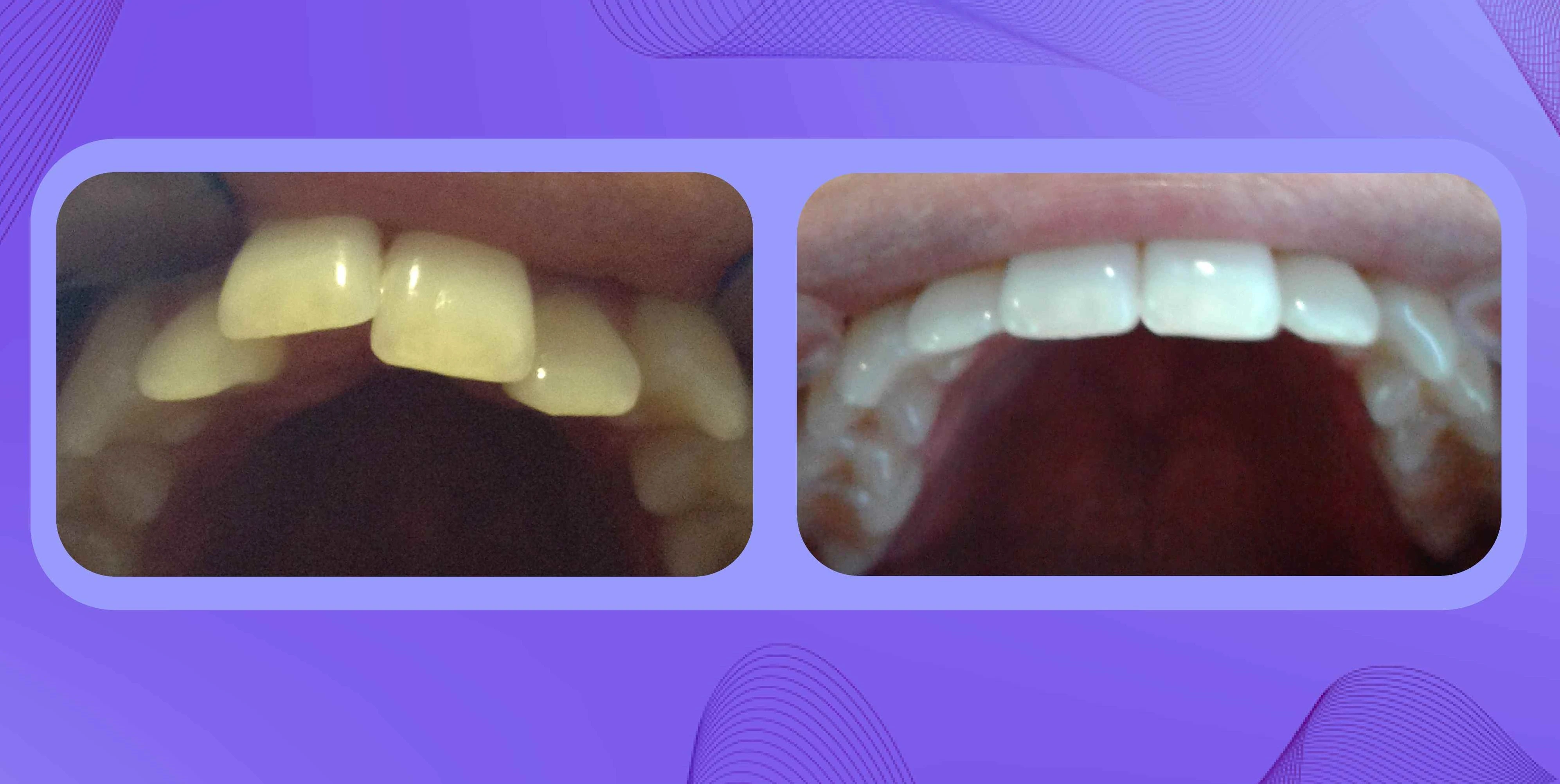 Antes y después de un caso de apiñamiento dental