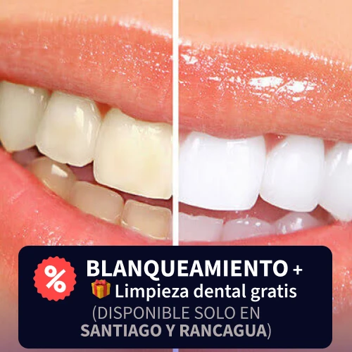 Blanqueamiento Dental