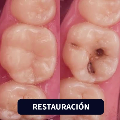 Restauración Dental
