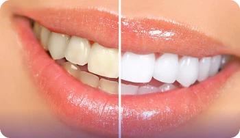 Blanqueamiento + Limpieza Dental