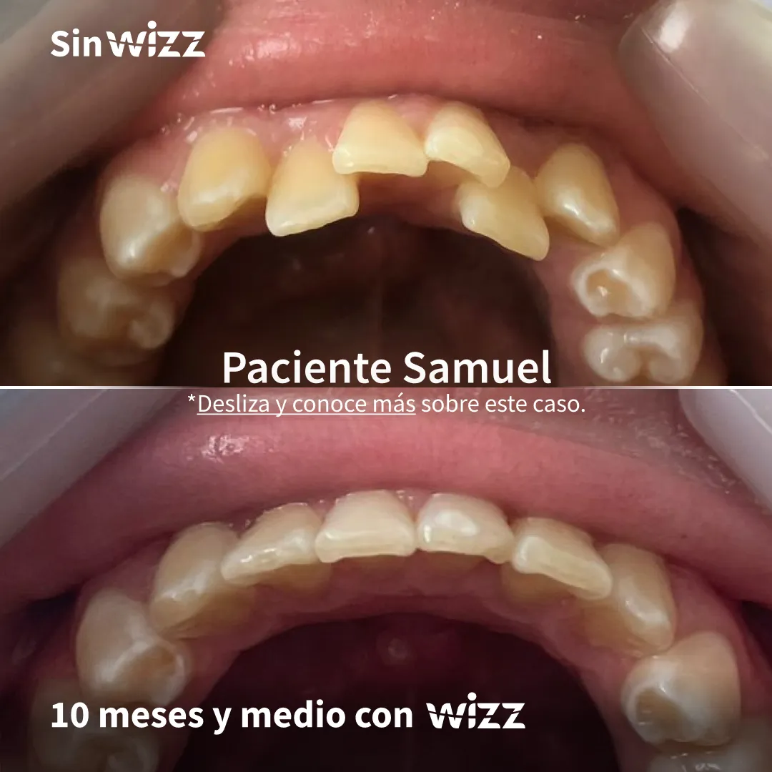 Antes y después de un paciente Wizz