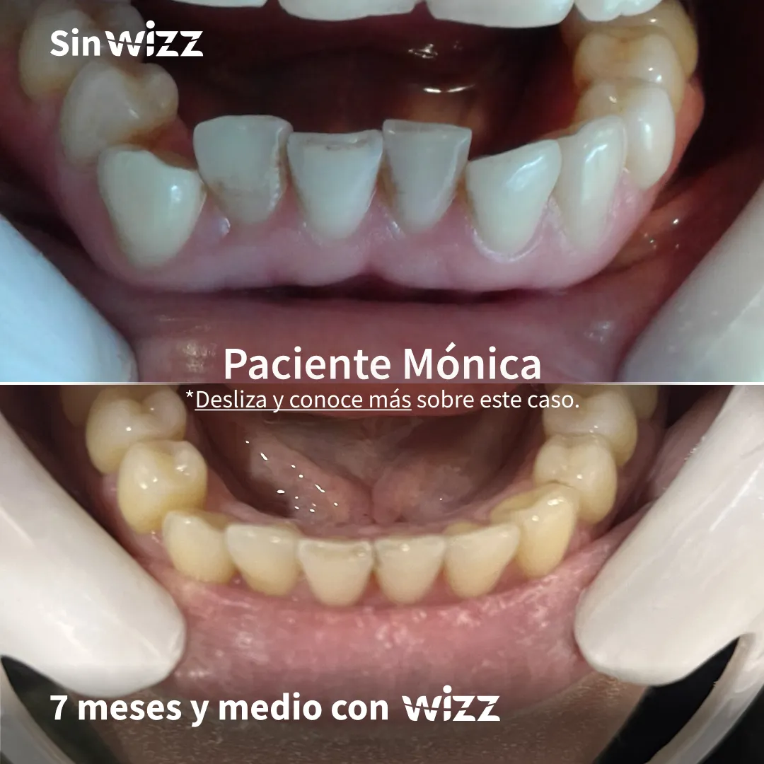 Antes y después de un paciente Wizz