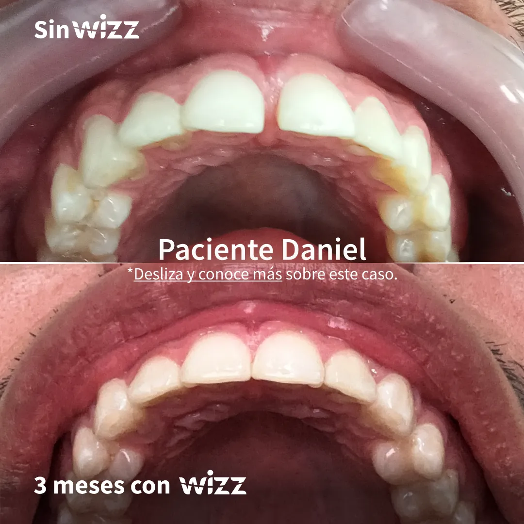 Antes y después de un paciente Wizz