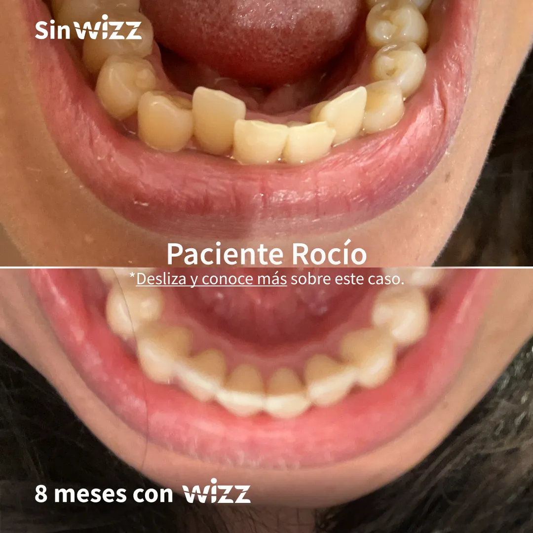 Antes y después de un paciente Wizz