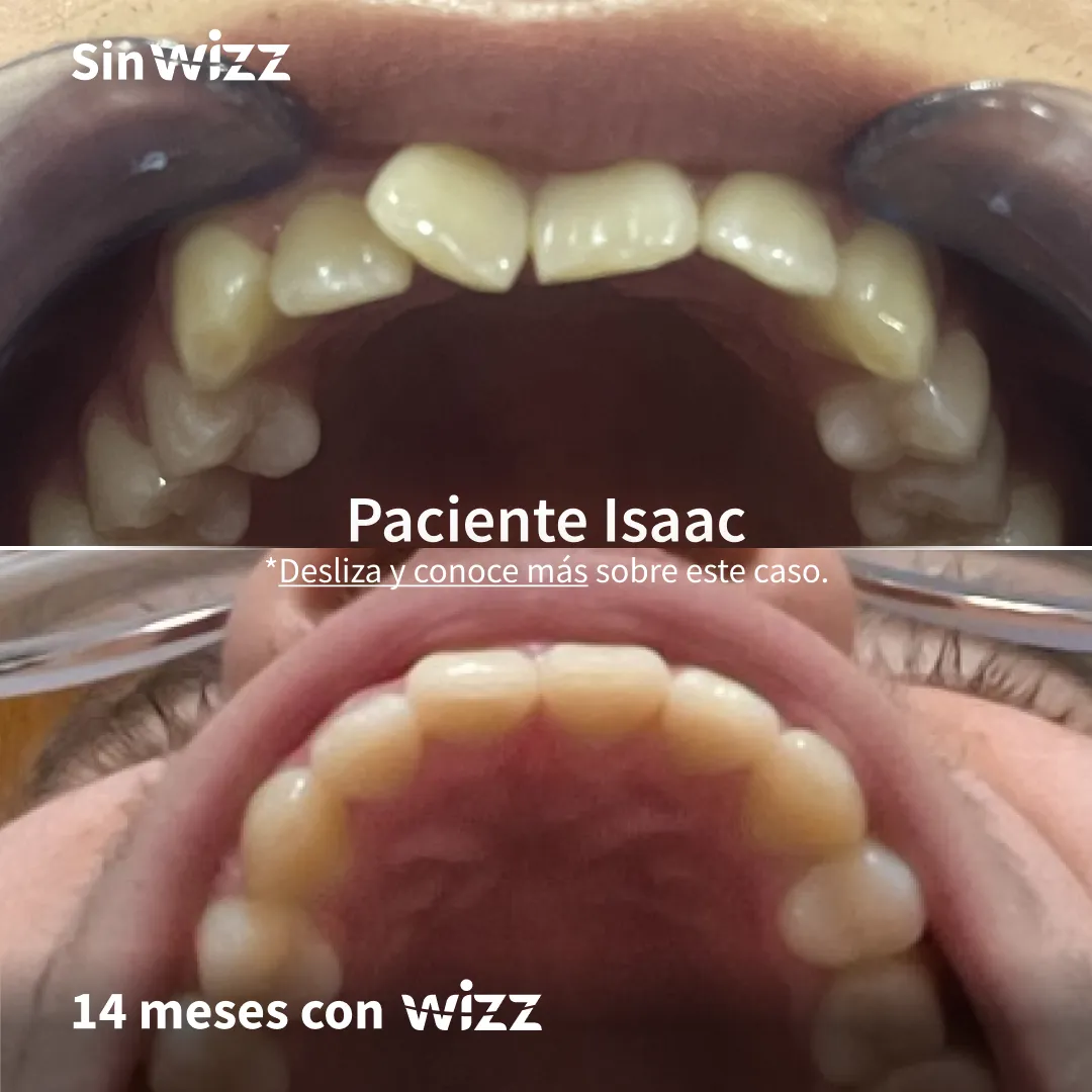 Antes y después de un paciente Wizz
