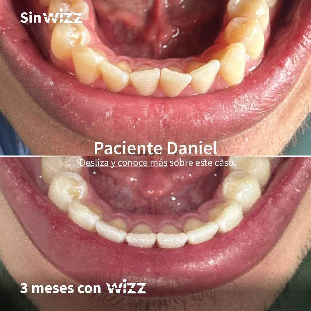 Antes y después de un paciente Wizz