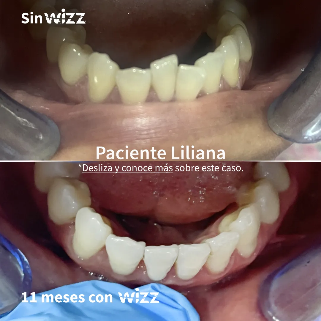Antes y después de un paciente Wizz